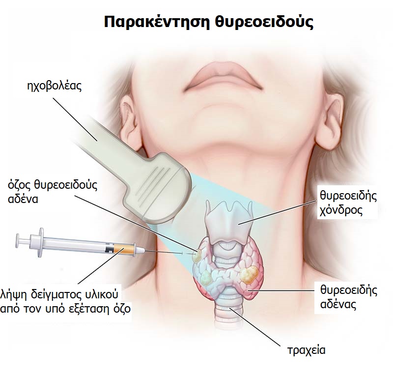 thyroid biopsy GR