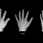 bone age sample 1