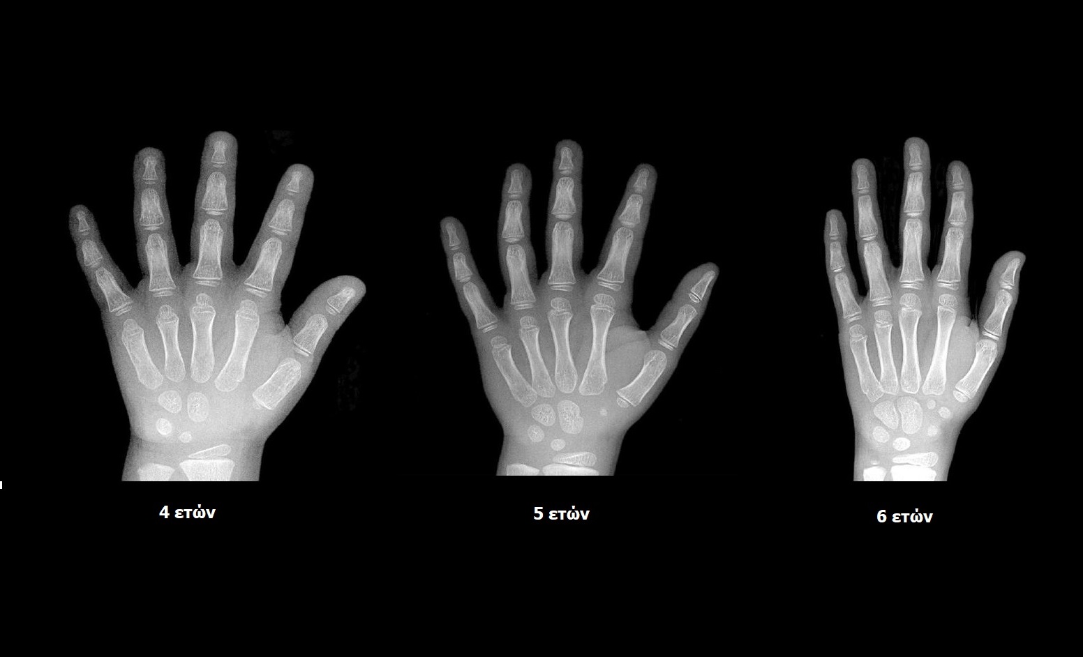 bone age sample 1